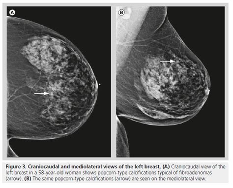 the villages breast cancer mammogram images|What Mammograms Show: Calcifications, Cysts, Fibroadenomas.